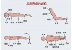 小褥疮大问题，请记住这些做法！